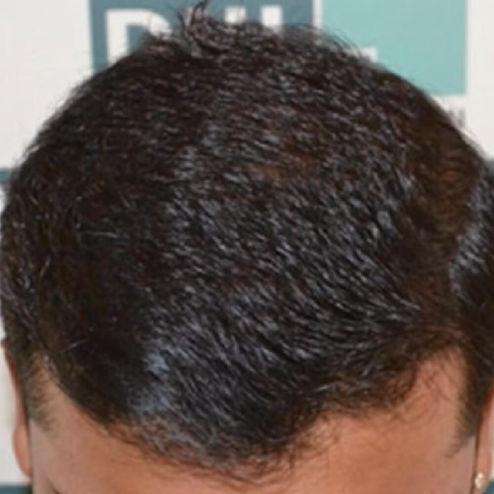 Nachher