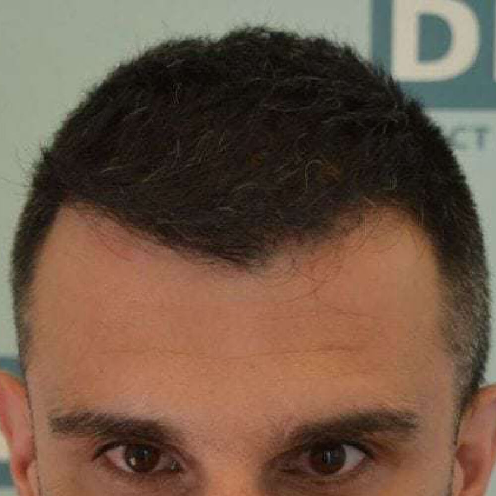 Nachher