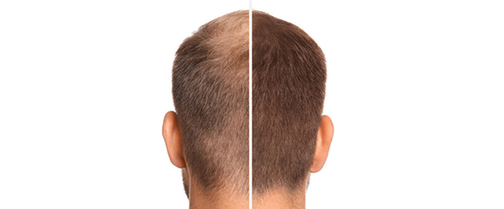 Meilensteine der Haartransplantation