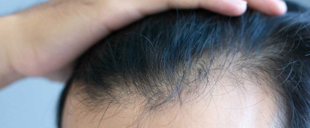 Unshaven – Haarverpflanzung ohne Rasur