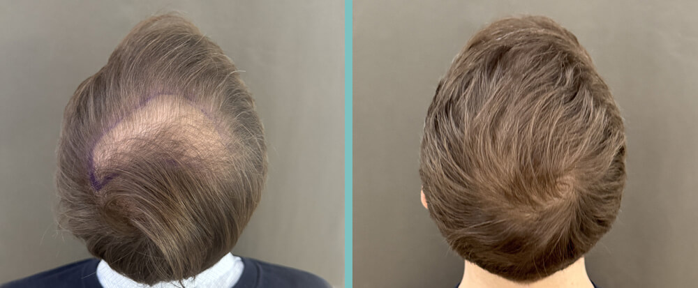Tonsur Haartransplantation vorher nachher