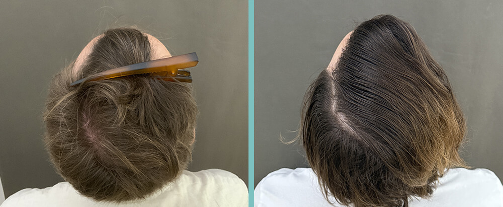 Haartransplantation vorher nachher