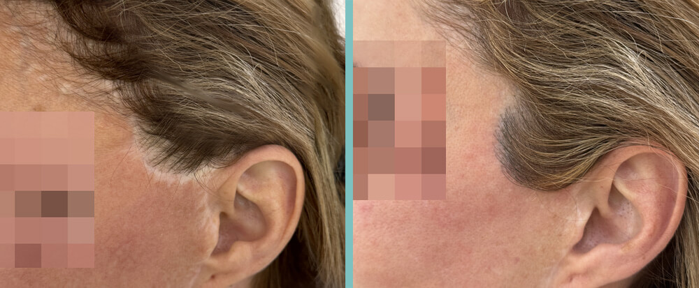 Frau Haartransplantation vorher / nachher