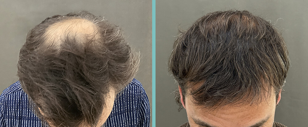Haartransplantation Tonsur vorher nachher