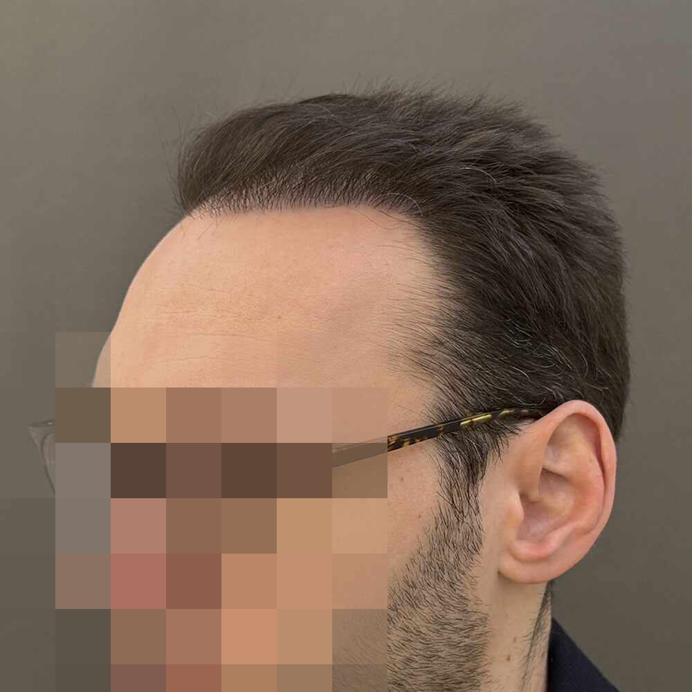 Nachher